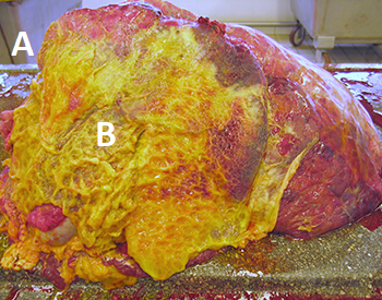 Acute fibrineuze pleuro-pneumonie