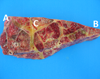 Acute fibrineuze pleuro-pneumonie