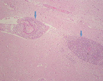 Chronische vasculitis hersenen