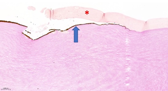 Met de Von Kossa-kleuring wordt onder de microscoop een band calcium (pijl) als donker materiaal zichtbaar op het hoornvlies, ter plaatse van de erosie. Het epitheel (*) van het hoornvlies laat los
