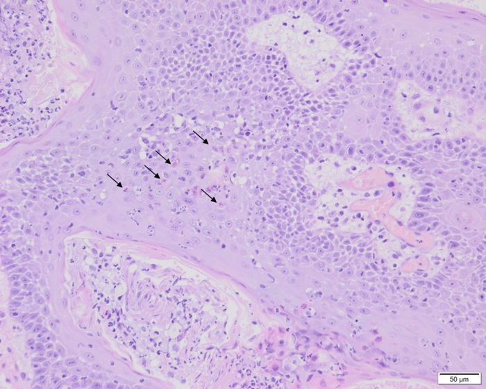 In het epitheel van de haarfollikels en de epidermis zijn opvallend veel eosinofiele, enigszins gekrompen keratinocyten met karyopyknose en karyorrhexis (zie pijlen), kenmerkend voor deze entiteit. Deze apoptotische keratinocyten zijn caspase 9-positief.