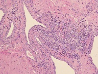 lymfoplasmacellulaire prostatis