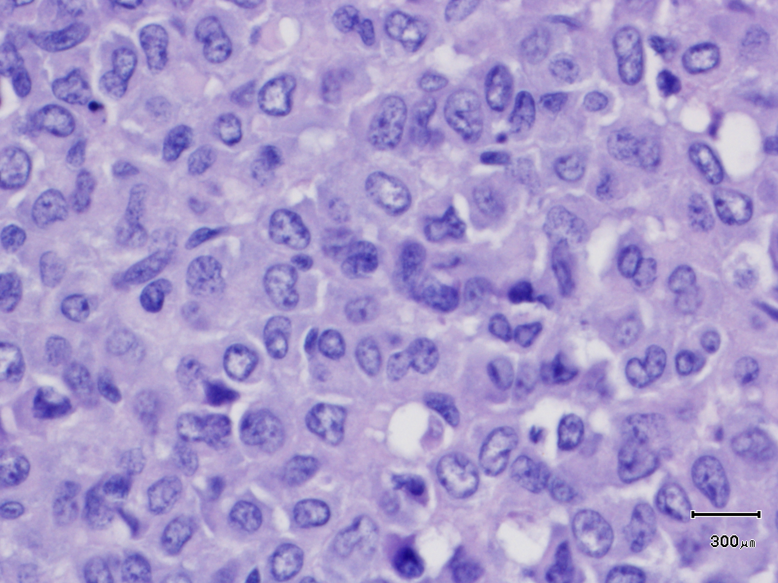 Multipele maligne tumor