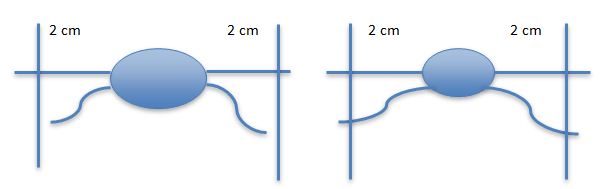 Mastocytoom